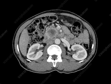 Pancreatic Cancer Ct Scan Stock Image C0294650 Science Photo