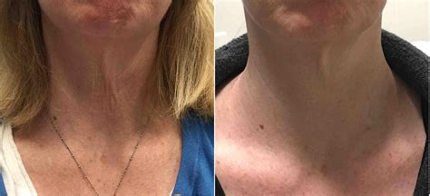 Genius Rf Microneedling Before And After Photo Gallery Washington Dc Mi Skin Dermatology