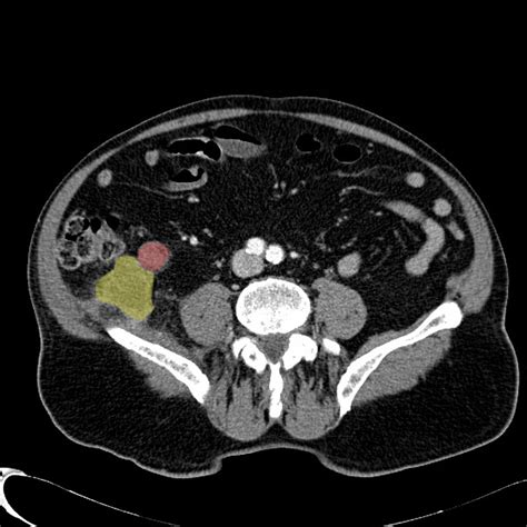 Appendix Cancer Ct Scan Wikidoc