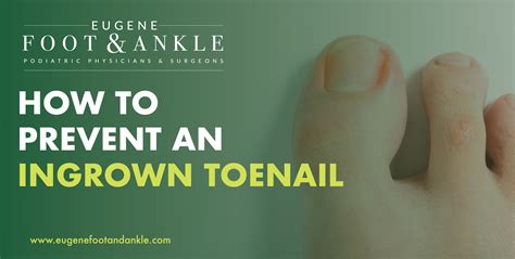 Ingrown Toenail Treatments And Prevention Eugene Foot And Ankle