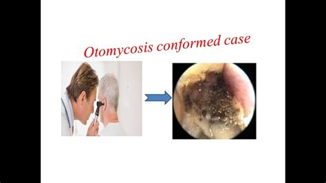 Otomycosis Conformed Case Koh Preparation Positive Youtube
