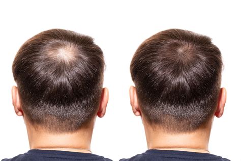How Does Platelet Rich Plasma Therapy Prp Work For Hair Loss David
