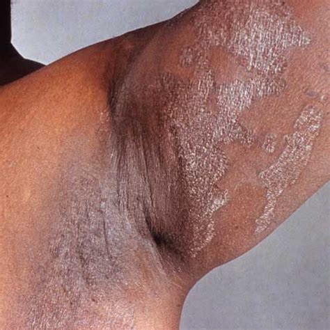 10 Common Bacterial Skin Infections
