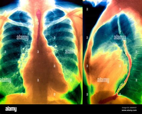 Enlarged Heart Coloured Chest X Rays Of A Frontal Left And A Left