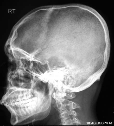 Depressed Skull Fracture Image