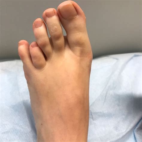 Toe Lengthening Surgery In Leeds Yorkshire Foot Hospitalyorkshire