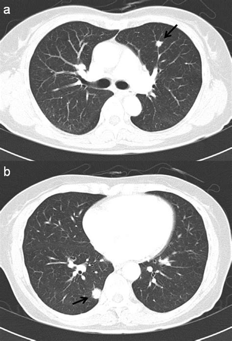 Chest Computed Tomography Showed Two Non Calcified Lung Nodules In The