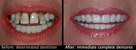 Immediate Dentures Denture Professionals Rockingham And Pinjarra