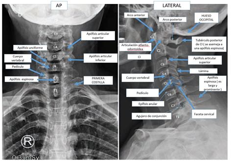 Radiografia De Cervicales