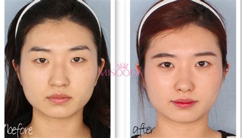 Why Korean Nose Augmentation Bridge And Tip Guide Reviews Promotions