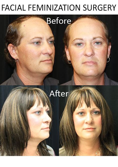 Male To Female Surgery Pictures Before And After Picturemeta