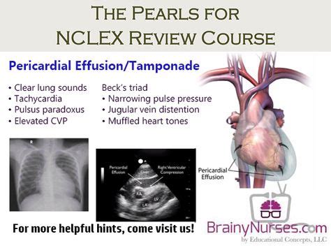 Pericardial Effusion And Tamponade Is The Accumulation Of Fluid Or