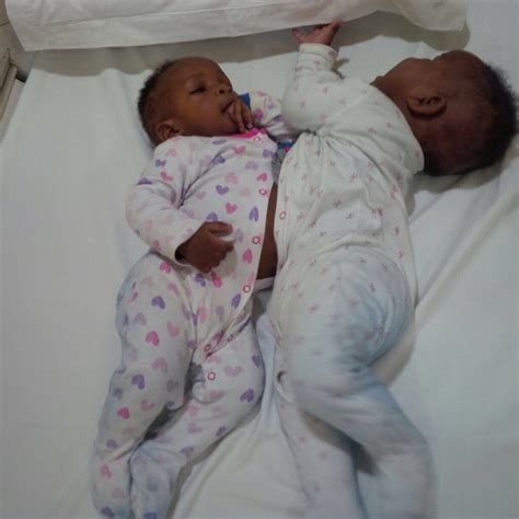 Nigerian Conjoined Twins Successfully Separated The Nation Newspaper