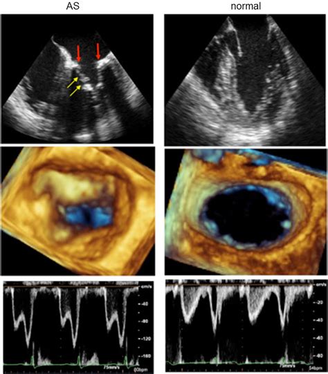 Calcific Extension Towards The Mitral Valve Causes Non Rheumatic Mitral