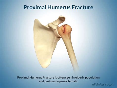 Proximal Humerus Fracture Treatment Exercises Causes Symptoms