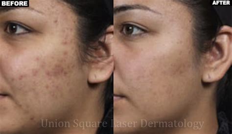 Acne Laser And Light Treatments Union Square Laser Dermatology