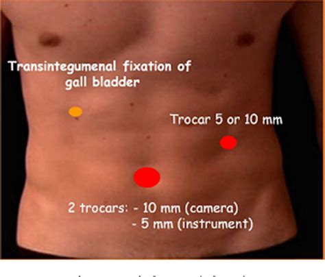 Figure 1 From Two Sites Incision Laparoscopic Cholecystectomy