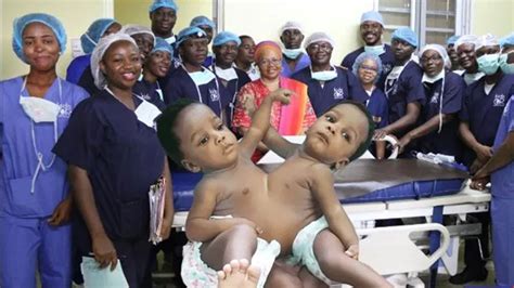 One Year Old Conjoined Twins Successfully Separated By Nigerian Doctors