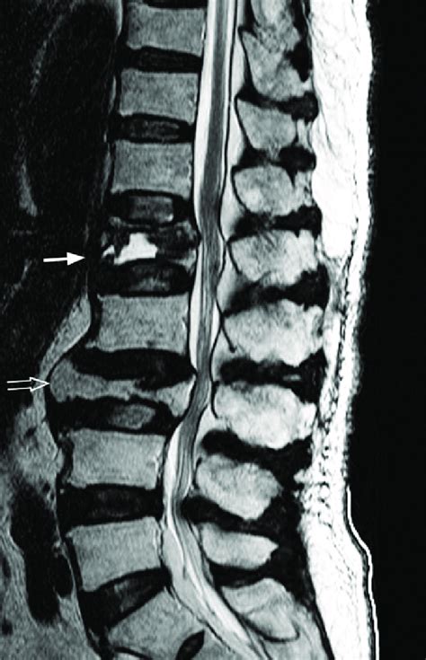 12 T2 Weighted Sagittal Mr Image Showing Typical Osteoporotic Type