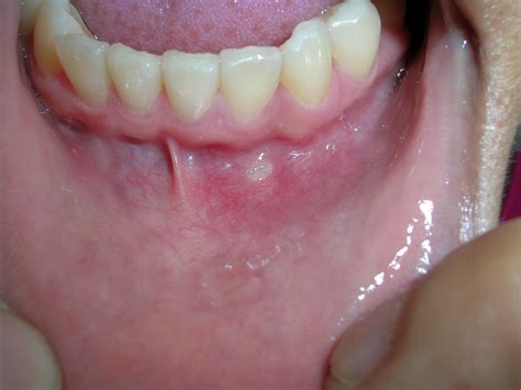 What Does A Canker Sore In The Mouth Look Like 9 Faqs About Canker