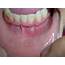 Painful Mouth Sore  MDedge Family Medicine