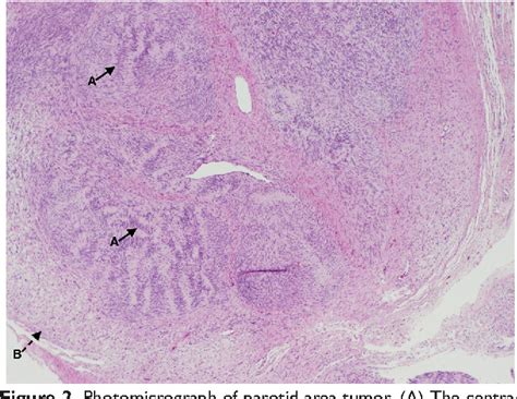 Pdf A Case Of Multiple Neurofibromaschwannoma Hybrid Tumors Of The