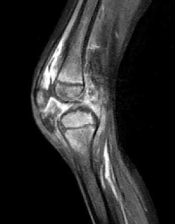 Septic Arthritis Of The Knee Pediatric Radiology Case Radiopaedia Org