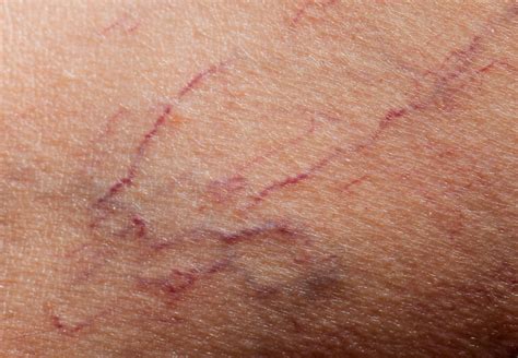 Spider Veins Dermatology Conditions And Treatments