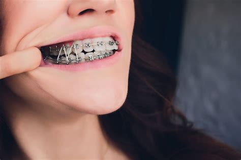 How To Eat With Braces Rubber Bands Orthodontic Rubber Bands More