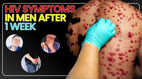 Hiv Symptoms In Men After 1 Week Youtube