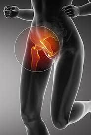 Groin pain may be as a result of a variety of reasons like infectious process, trauma, cancer, or other abnormalities. Chronic Groin Pain - More Than Just Osteitis Pubis ...