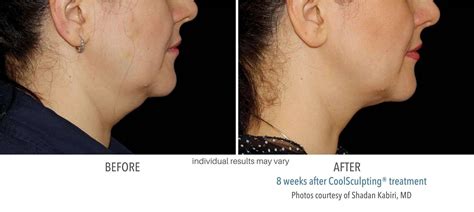 Coolsculpting Before And After Results From Real Patients