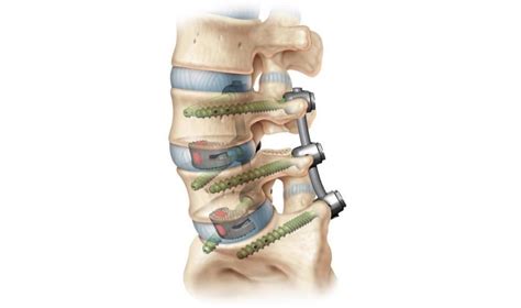 Spine Products Spinal Implants Depuy Synthes