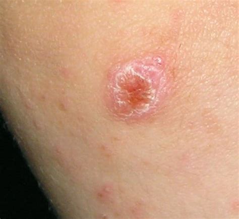 Spider Bite Pictures Symptoms And Treatments Youmemindbody