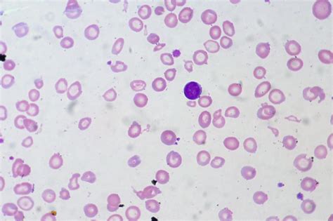 Microcytic Anaemias Almostadoctor