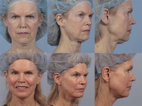 Facelift And Necklift Dr Brett Kotlus Cosmetic Oculoplastic Surgeon Nyc