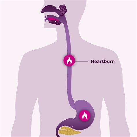 Heartburn Guide Symptoms Causes And Treatment Pyrocalm