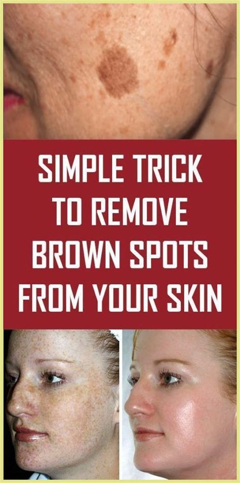 Simple Trick To Remove Brown Spots From Your Skin Spots On Face