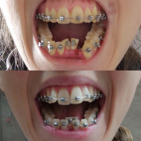 10 Weeks Of Braces Just Had An Extraction Yesterday Looking Forward