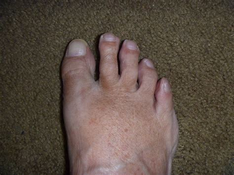I Have This Discoloration On My Feet And Toes It Looks Like
