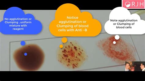 Abo blood group system, classification of human blood as determined by the presence or absence of a and b antigens on red blood cells. How to test to know ABO Blood group and Rh Typing by RJH ...
