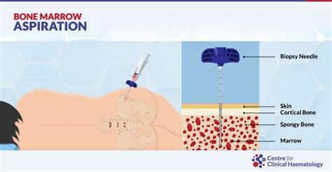 Bone Marrow Biopsy And Bone Marrow Aspiration Cfch Centre For