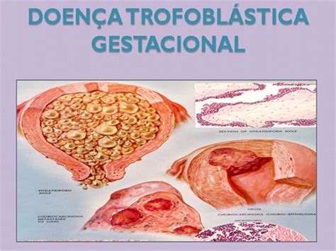 Doença Trofoblástica Gestacional Neoplasias Trofoblásticas Gestacionais