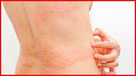 Токсикодермия лечение и диета Токсикодермия (токсидермия): симптомы, лечение, фото Токсикодермия (токсидермия): симптомы, лечение, фото Токсикодермия лечение и диета