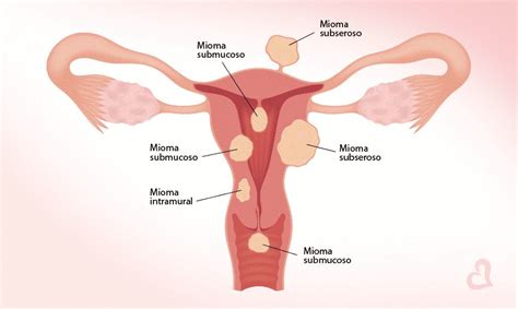 Miomas o que são sintomas e tratamentos Awor