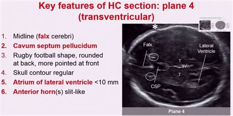 Anatomy Fetal Transventricular Plane Fetal T 4 Septum Plane