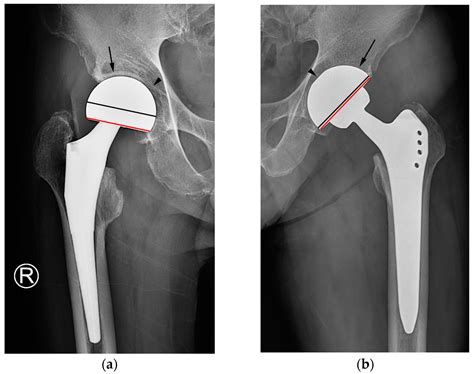 Jcm Free Full Text Deviation Of Latitude Cut A Simple Sign To Differentiate Total Hip