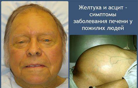 Лечение метастазов печени диета Признаки болезни печени симптомы и лечение, диета | plastika-info.ru Признаки болезни печени симптомы и лечение, диета | plastika-info.ru Лечение метастазов печени диета