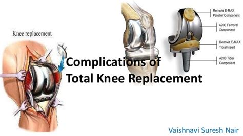 Complications Of Total Knee Replacement