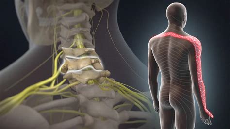 What Is C5 C6 Radiculopathy What Causes Cervical Radi